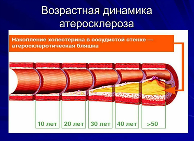 Возрастная динамика атеросклероза